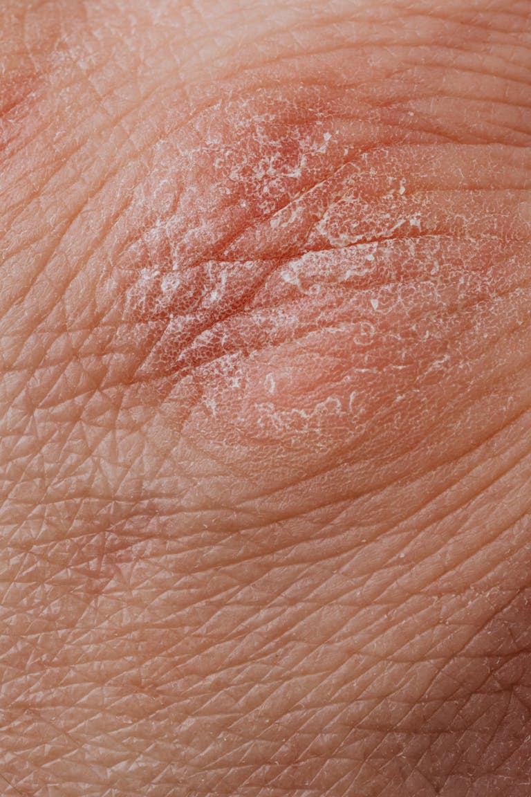 Psoriātiskais artrīts ir hroniska un daudzveidīga slimība, kas prasa savlaicīgu diagnostiku un ilgtermiņa ārstēšanu.