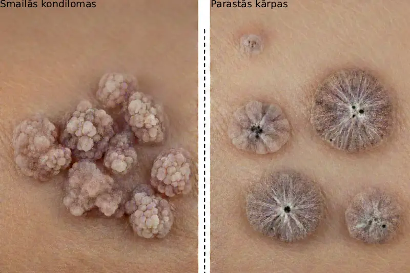 Ģenitālo un ādas kārpu salīdzinājums, ko izraisa cilvēka papilomas vīruss.